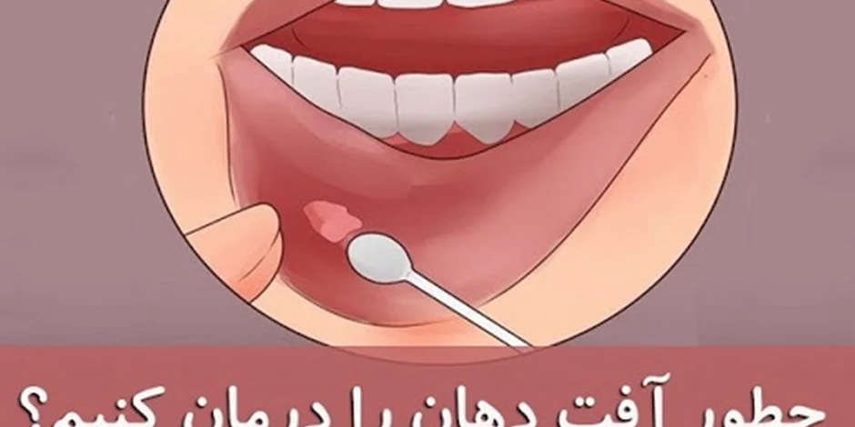 خداحافظی با آفت دهان در 24 ساعت